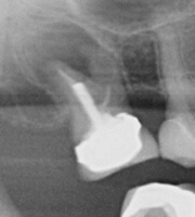 root-canal-xray-2